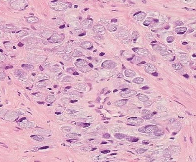 Linitis plastica pathophysiology - wikidoc