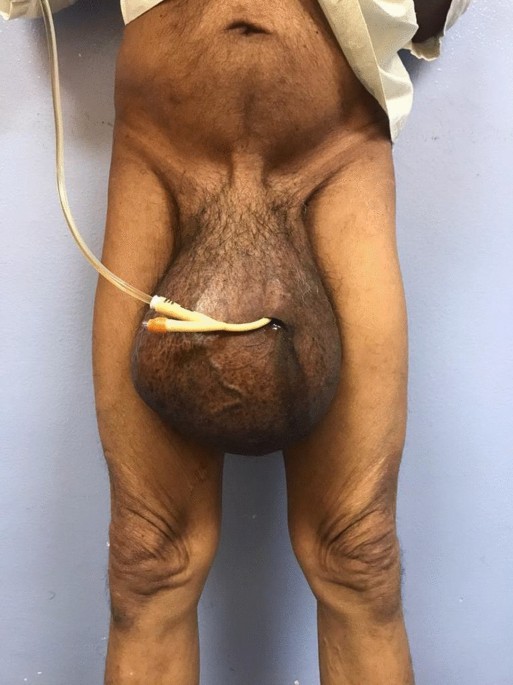 Unexpected huge testicular infarct complicating obstructed adult groin  hernia: a case report | African Journal of Urology | Full Text