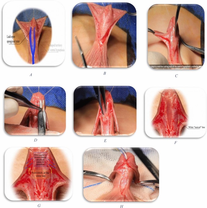 Can a platelet-rich plasma covering layer reduce urethrocutaneous fistula rate after distal penile hypospadias repair using the STAR (Seleim’s topography-guided anatomical reassembly) technique? A randomized controlled trial