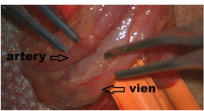 l carnitine varicocele Conservative management versus microsurgical varicocelectomy in subclinical with impaired semen parameters: a prospective randomized study | African Journal of Urology 80 Day - Varicocele Home