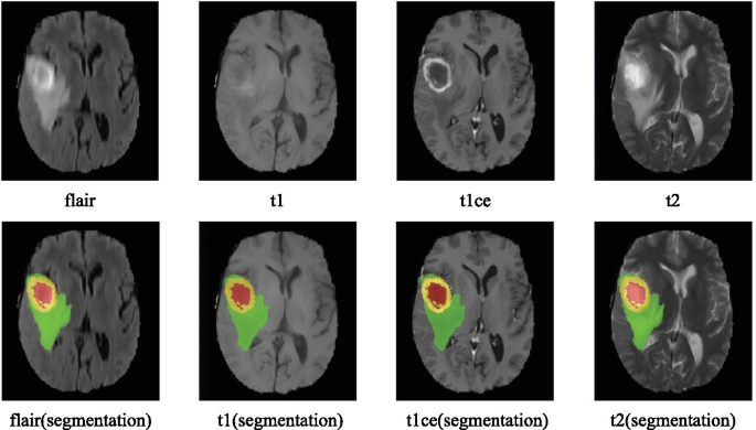 Automatic Brain Tumor Detection Using Convolutional Neural Networks