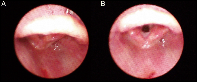 Comparison of vocal cord view between neutral and sniffing position during  orotracheal intubation using fiberoptic bronchoscope: a prospective,  randomized cross over study | BMC Anesthesiology | Full Text