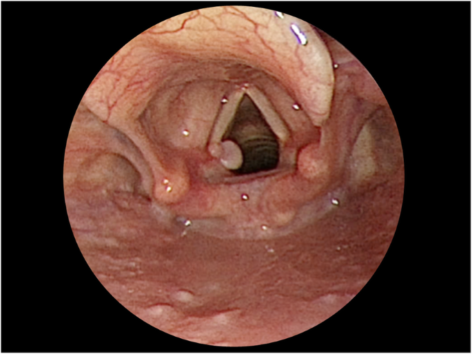 Vocal cord granuloma after transoral thyroidectomy using oral endotracheal  intubation: two case reports | BMC Anesthesiology | Full Text