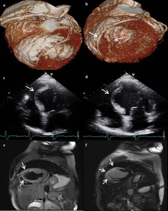 Update on Myocardial Bridging