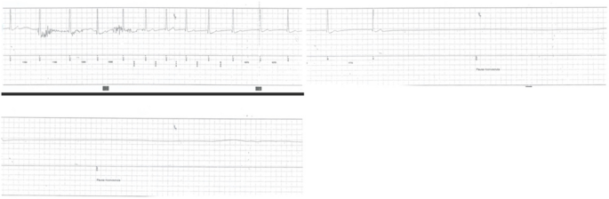 Syncope and Cannabis: hypervagotonia from chronic abuse? A case report and  literature review | BMC Cardiovascular Disorders