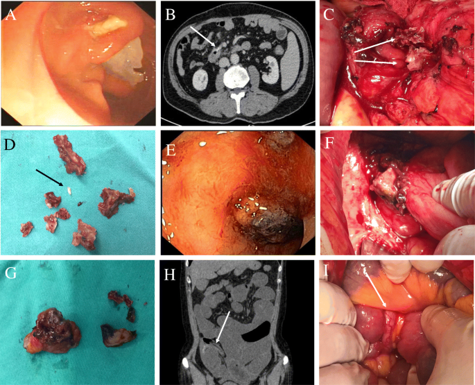 Serious postoperative complications induced by medical glue: three case  reports, BMC Gastroenterology