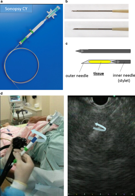 Utility of a 21-gauge Menghini-type biopsy needle with the rolling method  for an endoscopic ultrasound-guided histological diagnosis of autoimmune  pancreatitis: a retrospective study | BMC Gastroenterology | Full Text