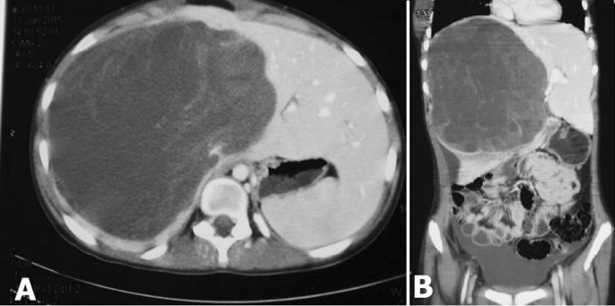 melanotic sarcoma liver A large undifferentiated sarcoma of the liver in a 13-year-old girl treated  with anatomical resection: a case report and review of the literature | BMC  Gastroenterology