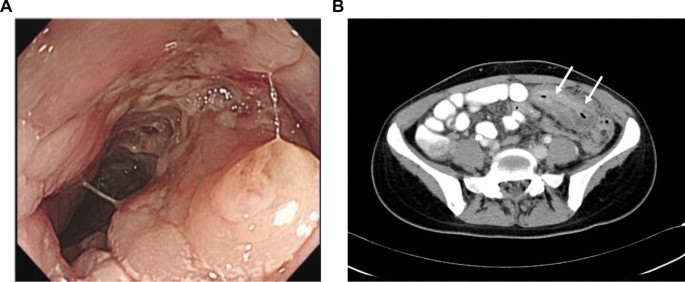 Presentation of signet ring cell type at carcinoma ventriculi of the  patient aged 20 years old