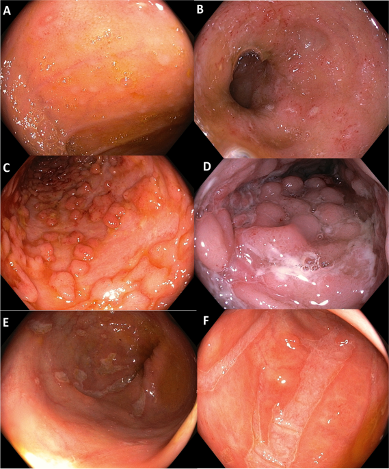 Capsule Endoscopy: Ulcerative Colitis Symptoms & Crohn's Disease Test
