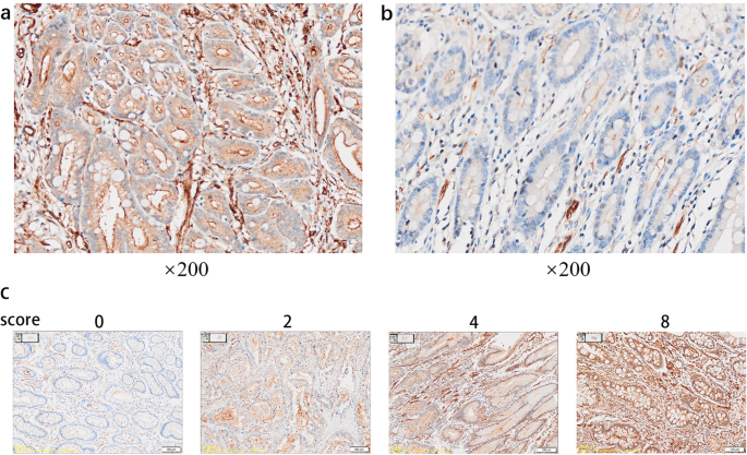Clinicopathological features and prognostic significance of TAF1L in gastric cancer