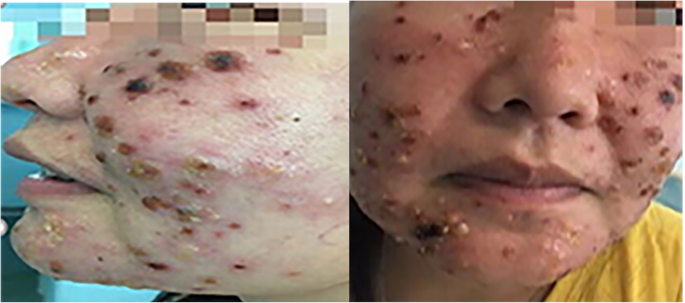 Hydroa Vacciniforme-like Lymphoproliferative disorder in an adult invades  the liver and bone marrow with clear pathological evidence: a case report  and literature review | BMC Infectious Diseases | Full Text