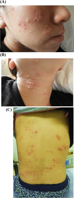Eczema During Pregnancy