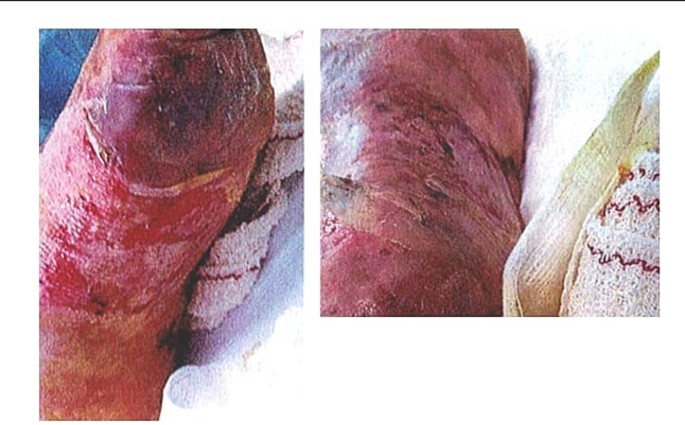 Streptococcal toxic shock syndrome revealed phlegmasia cerulea dolens of the arm - The Lancet Infectious Diseases