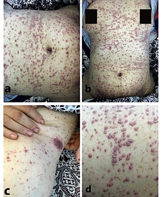 Kaposi varicelliform eruption: an unusual presentation caused by varicella  zoster virus in a healthy adult patient - a case report, BMC Infectious  Diseases