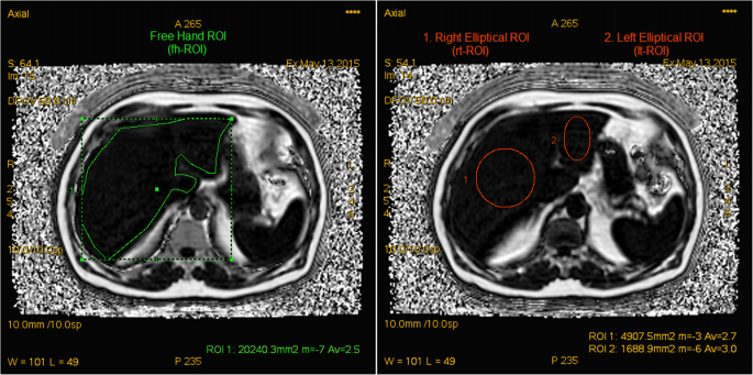 Measuring liver fat fraction with complex-based chemical shift MRI: the  effect of simplified sampling protocols on accuracy | BMC Medical Imaging