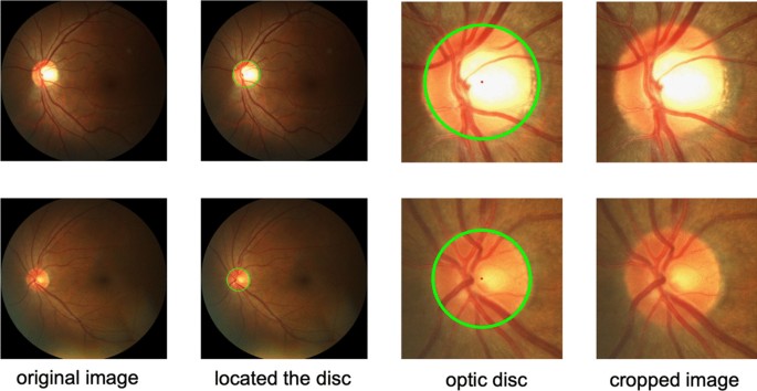 Joint optic disc and cup segmentation based on densely connected