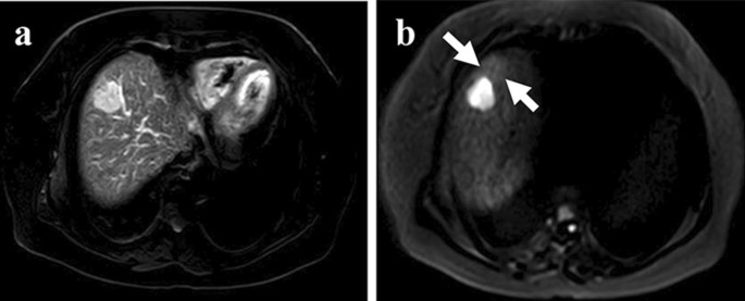 Value of gadoxetic acid-enhanced MRI for microvascular invasion of