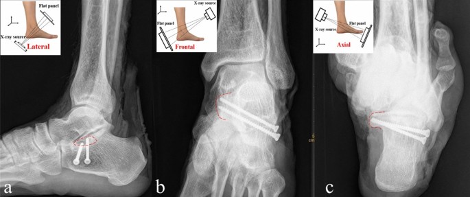 Results and observations in operative treatment of displaced intra-  articular calcaneal fractures with use of Calcanail®