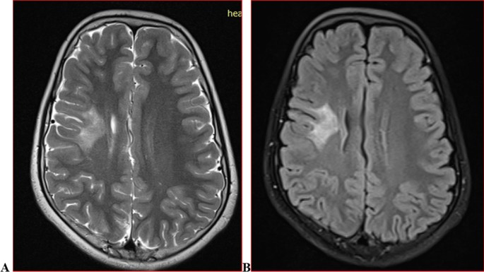 Brain magnetic resonance imaging findings among children with epilepsy in  two urban hospital settings, Kampala-Uganda: a descriptive study | BMC  Medical Imaging | Full Text