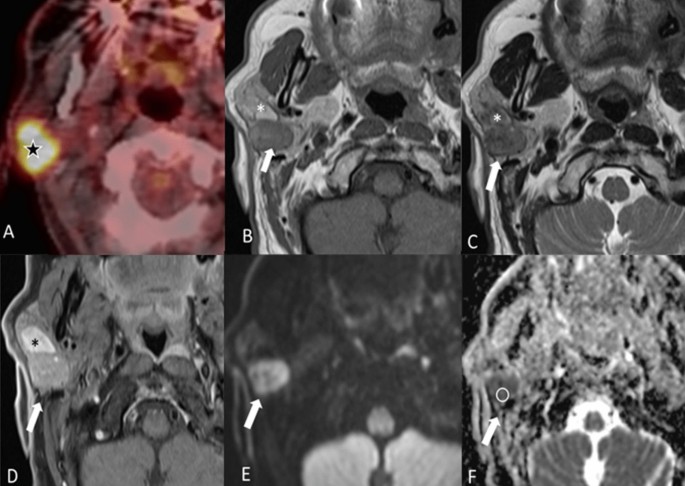 Marginal mandibular nerve, Radiology Reference Article