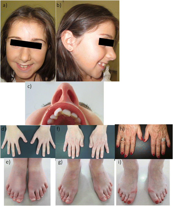 Dermatologic Manifestations of Rubinstein-Taybi Syndrome Clinical