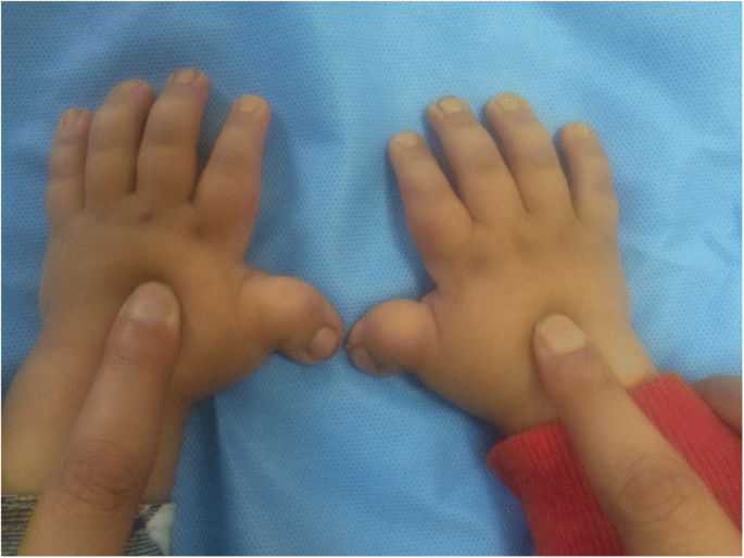 Molecular studies in 10 cases of Rubinstein-Taybi syndrome
