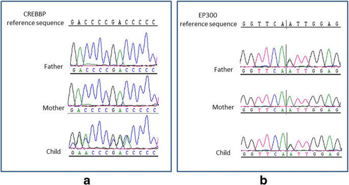 Fetal phenotype of Rubinstein‐Taybi syndrome caused by CREBBP mutations -  Van‐Gils - 2019 - Clinical Genetics - Wiley Online Library