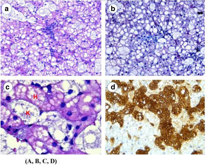 Niemann-Pick disease type-B: a unique case report with compound