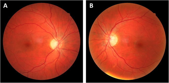 An 18-year-old man with dominant optic atrophy (DOA). The fundus