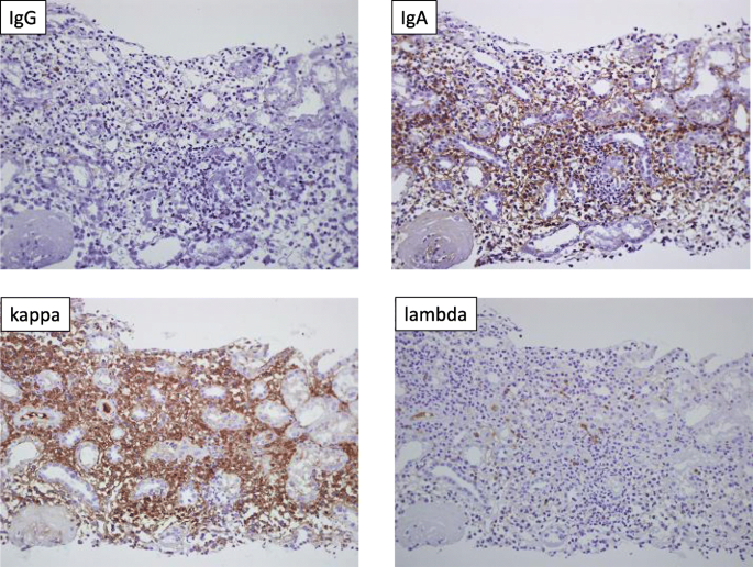 Tubulointerstitial nephritis with monotypic lympho-plasmacytic infiltrates  in a patient with primary Sjögren's syndrome accompanied by IgA-type  monoclonal gammopathy | BMC Nephrology | Full Text