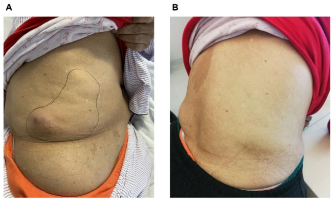 lipo b-c pills yellow urine Anti-PD-1 immunotherapy for the treatment of metastatic urothelial carcinoma in a kidney transplant recipient: a case report | BMC Nephrology Buy 2 @ ₹599 Packaging:Zip-Lock Eco Bag l acetyl carnitine benefits