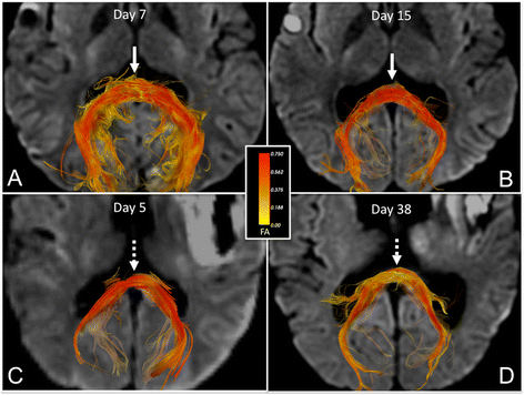 Diffusion Tensor Imaging in Traumatic Brain Injury