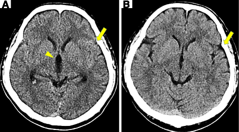 Subarachnoid Hemorrhage - What You Need to Know