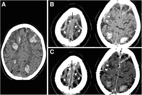 cortical vein thrombosis