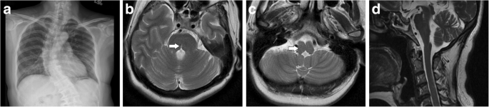 Horizontal gaze palsy