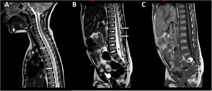 Congenital spinal dermal tract: how accurate is clinical and radiological  evaluation? in: Journal of Neurosurgery: Pediatrics Volume 15 Issue 6  (2015) Journals