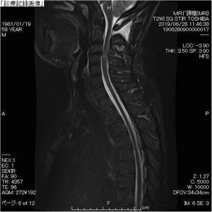 Cerebrospinal fluid leak presented with the C1-C2 sign caused by spinal  canal stenosis: a case report | BMC Neurology | Full Text