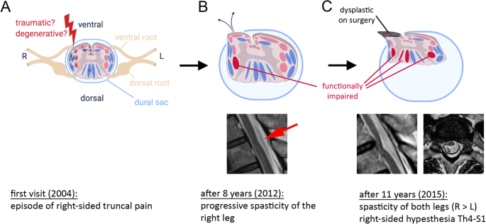 Long-term course of anterior spinal cord herniation presenting with an  upper motor neuron syndrome: case report illustrating diagnostic and  therapeutic implications | BMC Neurology | Full Text