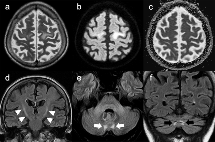 Coexistence of neuronal intranuclear inclusion disease and amyotrophic lateral sclerosis: an autopsy case