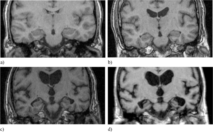 Validity and reliability of the medial temporal lobe atrophy scale in a  memory clinic population | BMC Neurology | Full Text