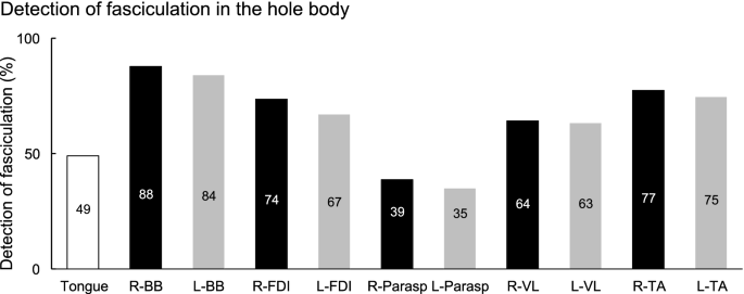 Fasciculation intensity and limb dominance in amyotrophic lateral sclerosis: a muscle ultrasonographic study