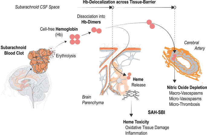 Subarachnoid Hemorrhage (SAH) - Trial Exhibits Inc.