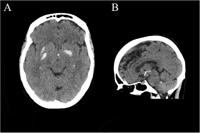 retatrutide ganglia hemorrhage A case of spontaneous basal ganglia hemorrhage with contralateral extension  utilizing the canal of Gratiolet | BMC Neurology