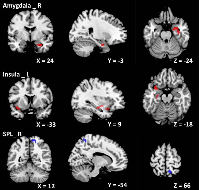 Abnormal alterations of regional spontaneous neuronal activity and  functional connectivity in insomnia patients with difficulty falling  asleep: a resting-state fMRI study, BMC Neurology