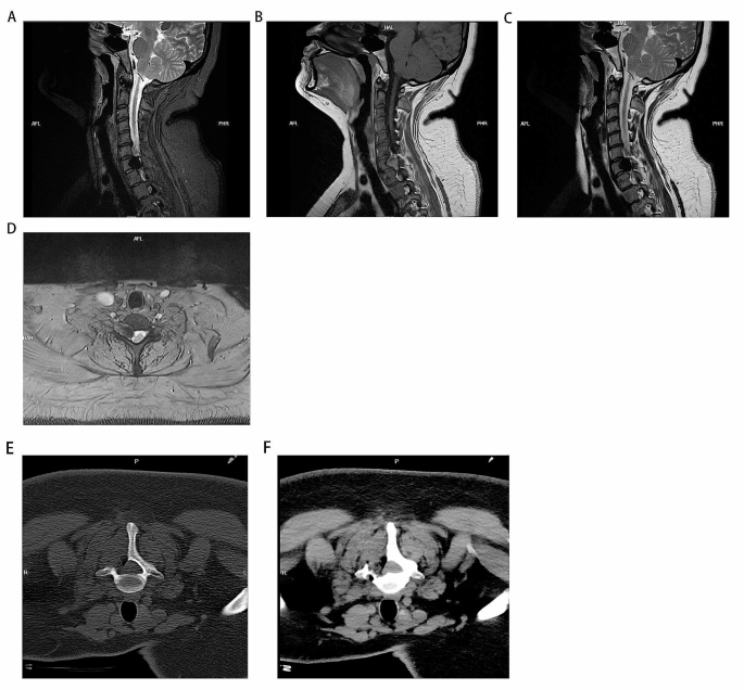 metastatic melanotic schwannoma Malignant melanotic schwannoma of the cervical spinal cord: a case report |  BMC Neurology
