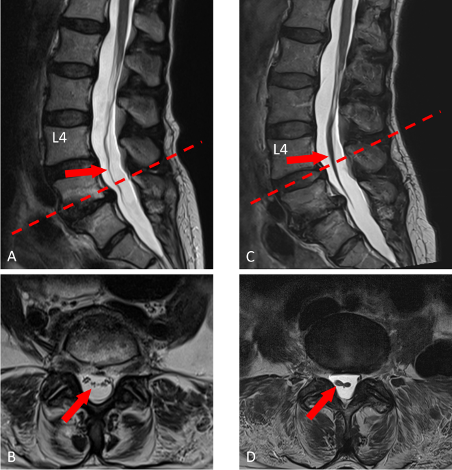 Conus medullaris and cauda equina syndrome as complications of non-imaging guided epidural steroid injection: two case reports with comprehensive interdisciplinary work-up