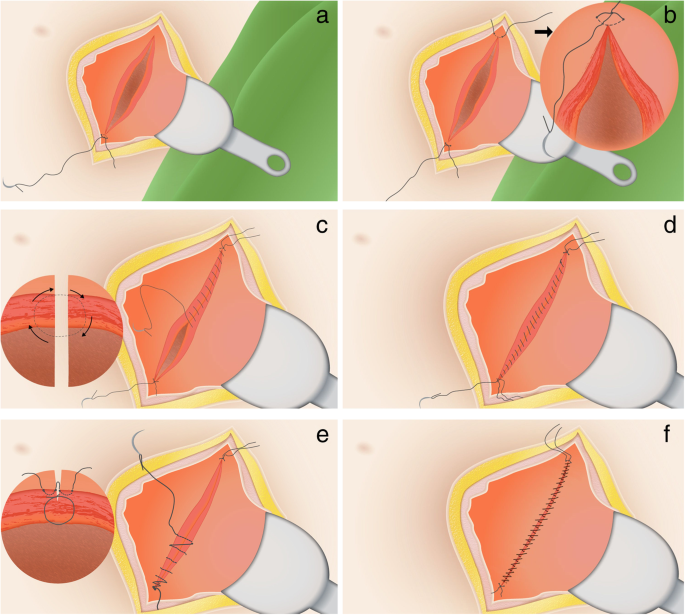 Single- versus double-layer closure of the caesarean (uterine