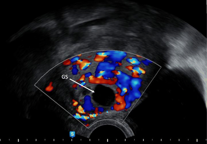 Ectopic Pregnancy: A Trainee's Guide to Making the Right Call: Women's  Imaging | RadioGraphics