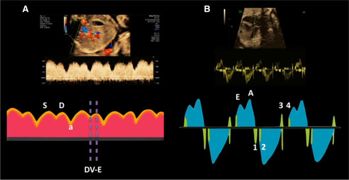 Reference values for fetal Doppler-based cardiocirculatory indices in  monochorionic-diamniotic twin pregnancy | BMC Pregnancy and Childbirth |  Full Text